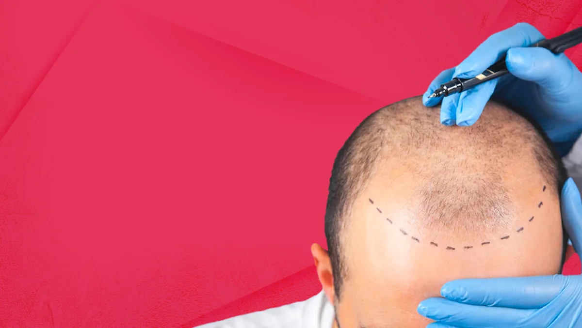Hair Transplant